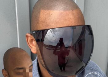 Scalp Micropigmentation: Wooster’s Trusted Hair Restoration Solution