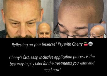Transforming Hair Loss Solutions with Scalp Micropigmentation